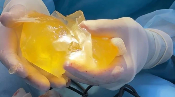 Силиконовая грудь взорвалась у блогерши во время тренировки в зале