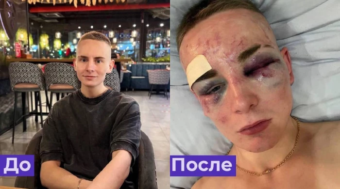 Жителя Пензы избили до полусмерти, превратив его голову в одну гигантскую гематому