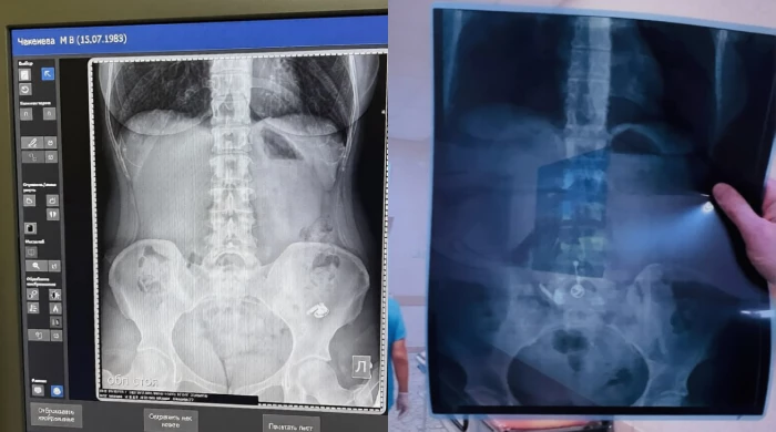 Жительница Уфы проглотила наушник, думая, что это таблетка